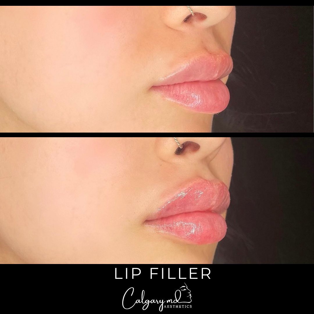 Lip perfection by @thelipgirlyouneed! 💋⁣
⁣
Melia will be returning to the office July 5th from her euro trip. ⁣
⁣
As a welcome back, Melia will be offering 𝗕𝗨𝗬 𝟮, 𝗚𝗘𝗧 𝟭 𝗙𝗥𝗘𝗘 𝘀𝘆𝗿𝗶𝗻𝗴𝗲𝘀* for the month of July. She can't wait to put all her new knowledge to work!⁣
⁣
Book your appointment today.⁣
𝗖𝗮𝗹𝗹: 403.242.1411​​​​​​​​ ⁣​​​​​​​​​​​​​​​​​​​​​​​​​​​​​​​​⁣​​​​​​​​​​​​​​​​​​​​​​​​⁣
𝗕𝗼𝗼𝗸 𝗼𝗻𝗹𝗶𝗻𝗲: calgarymdaesthetics.com/booking/⁣
⁣
*Valid for Revanesse only