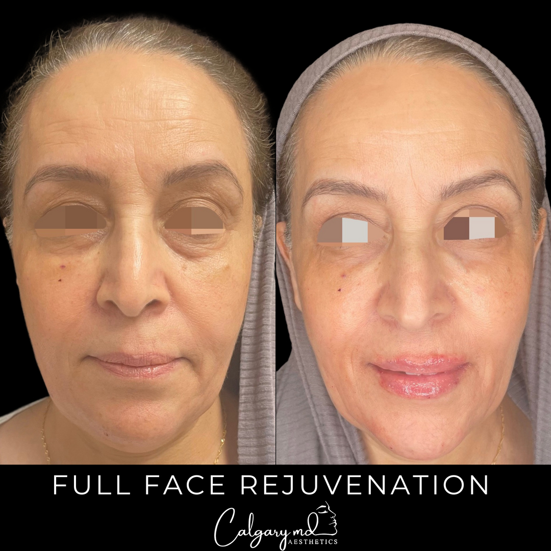 We 𝗟𝗢𝗩𝗘 full face rejuvenations! ❤️⁣​​​​​​​​
⁣​​​​​​​​
If you are looking to treat multiple areas, now is the perfect time to take advantage of our 𝗕𝗨𝗬 𝟮, 𝗚𝗘𝗧 𝟭 𝗙𝗥𝗘𝗘 𝘀𝘆𝗿𝗶𝗻𝗴𝗲. ⁣​​​​​​​​
⁣​​​​​​​​
Book your free consultation today!⁣​​​​​​​​
𝗖𝗮𝗹𝗹: 403.242.1411​​​​​​​​ ⁣​​​​​​​​​​​​​​​​​​​​​​​​​​​​​​​​⁣​​​​​​​​​​​​​​​​​​​​​​​​⁣​​​​​​​​
𝗕𝗼𝗼𝗸 𝗼𝗻𝗹𝗶𝗻𝗲: calgarymdaesthetics.com/booking/⁣​​​​​​​​
⁣​​​​​​​​
*treatment performed by @thelipgirlyouneed⁣​​​​​​​​
*please do not repost or reproduce without express written consent