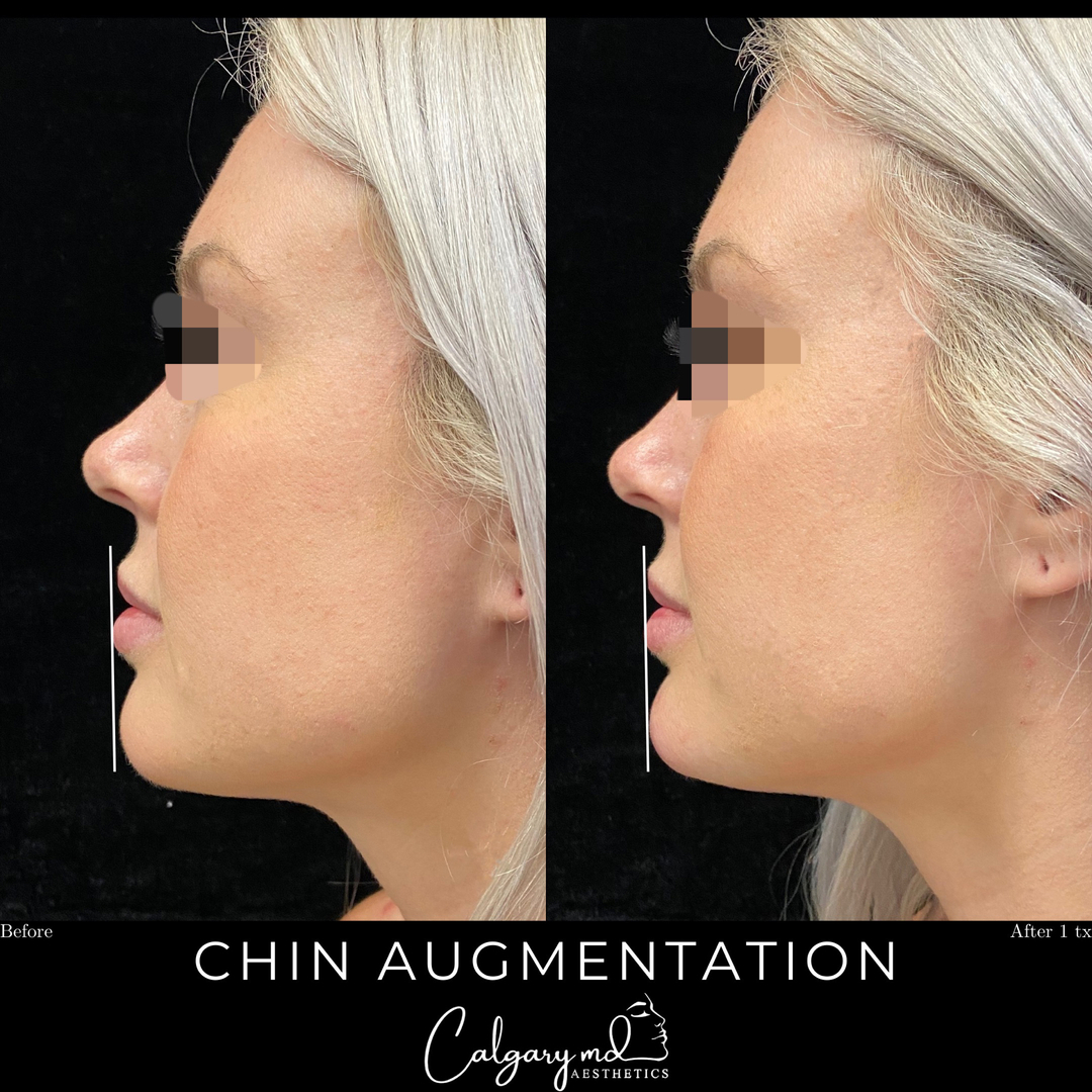 Profile balancing with Chin Augmentation!​​​​​​​​
​​​​​​​​
The slight deficiency of the chin was corrected using dermal filler.​​​​​​​​
​​​​​​​​
Contact us today to find out of this treatment is right for you!​​​​​​​​
𝗖𝗮𝗹𝗹: 403.242.1411​​​​​​​​ ⁣​​​​​​​​​​​​​​​​​​​​​​​​​​​​​​​​⁣​​​​​​​​​​​​​​​​​​​​​​​​⁣​​​​​​​​​​​​​​​​​​​​​​​​
𝗕𝗼𝗼𝗸 𝗼𝗻𝗹𝗶𝗻𝗲: calgarymdaesthetics.com/booking/⁣​​​​​​​​​​​​​​​​
​​​​​​​​
*treatment performed by @goodgenethetics (Linda)