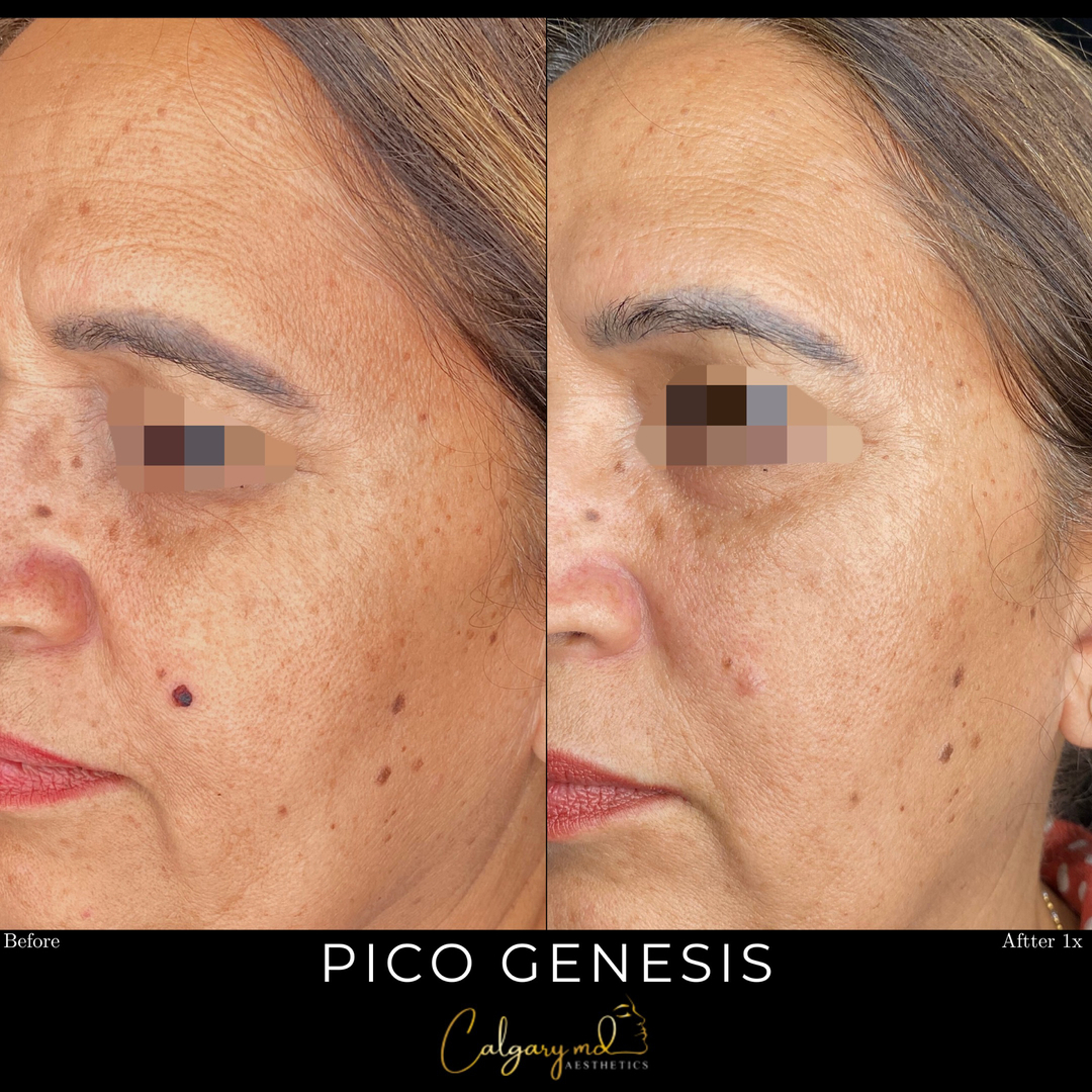 The Power of PICO! Say goodbye to uneven skin tone and hello to a more clear, radiant complexion.* PICO Genesis is safe on all skin colours and skin types. These results after one session. ​​​​​​​​
​​​​​​​​
Contact us today to book your free consultation:​​​​​​​​
𝗖𝗮𝗹𝗹: 403.242.1411​​​​​​​​ ⁣​​​​​​​​​​​​​​​​​​​​​​​​​​​​​​​​⁣​​​​​​​​​​​​​​​​​​​​​​​​⁣​​​​​​​​​​​​​​​​​​​​​​​​​​​​​​​​​​​​​​​​​​​​​​​​​​​​​​​​​​​​​​​​​​​​​​​​​​​​​​​​
𝗕𝗼𝗼𝗸 𝗼𝗻𝗹𝗶𝗻𝗲: calgarymdaesthetics.com/booking/⁣​​​​​​​​​​​​​​​​​​​​​​​​​​​​​​​​​​​​​​​​​​​​​​​​
​​​​​​​​
*a series of 3 sessions is recommended for optimal results​​​​​​​​
*individual results will vary.