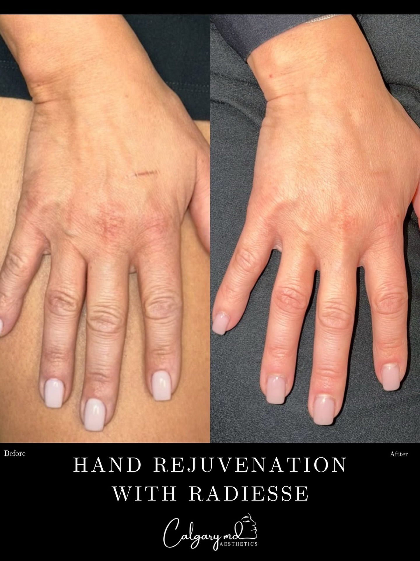 Your hands deserve a little anti-aging love too! ✨

We spend so much time focusing on facial rejuvenation, but our hands are often one of the first places to show signs of aging.

Radiesse® isn’t just for the face! 💉

This collagen-stimulating injectable helps restore lost volume and improve the appearance of aging hands by:

✨ Softening the appearance of prominent veins and tendons
✨ Restoring youthful-looking fullness
✨ Improving skin texture and firmness over time
✨ Stimulating natural collagen production
✨ Creating smoother, more rejuvenated-looking hands

The results speak for themselves! 🤍

Because your hands deserve the same attention as your face.

📲 Book your consultation through the link in our bio.

Individual results may vary.

#CalgaryMDAesthetics #Radiesse #HandRejuvenation #CollagenStimulation CalgaryAesthetics HandFiller SkinRejuvenation