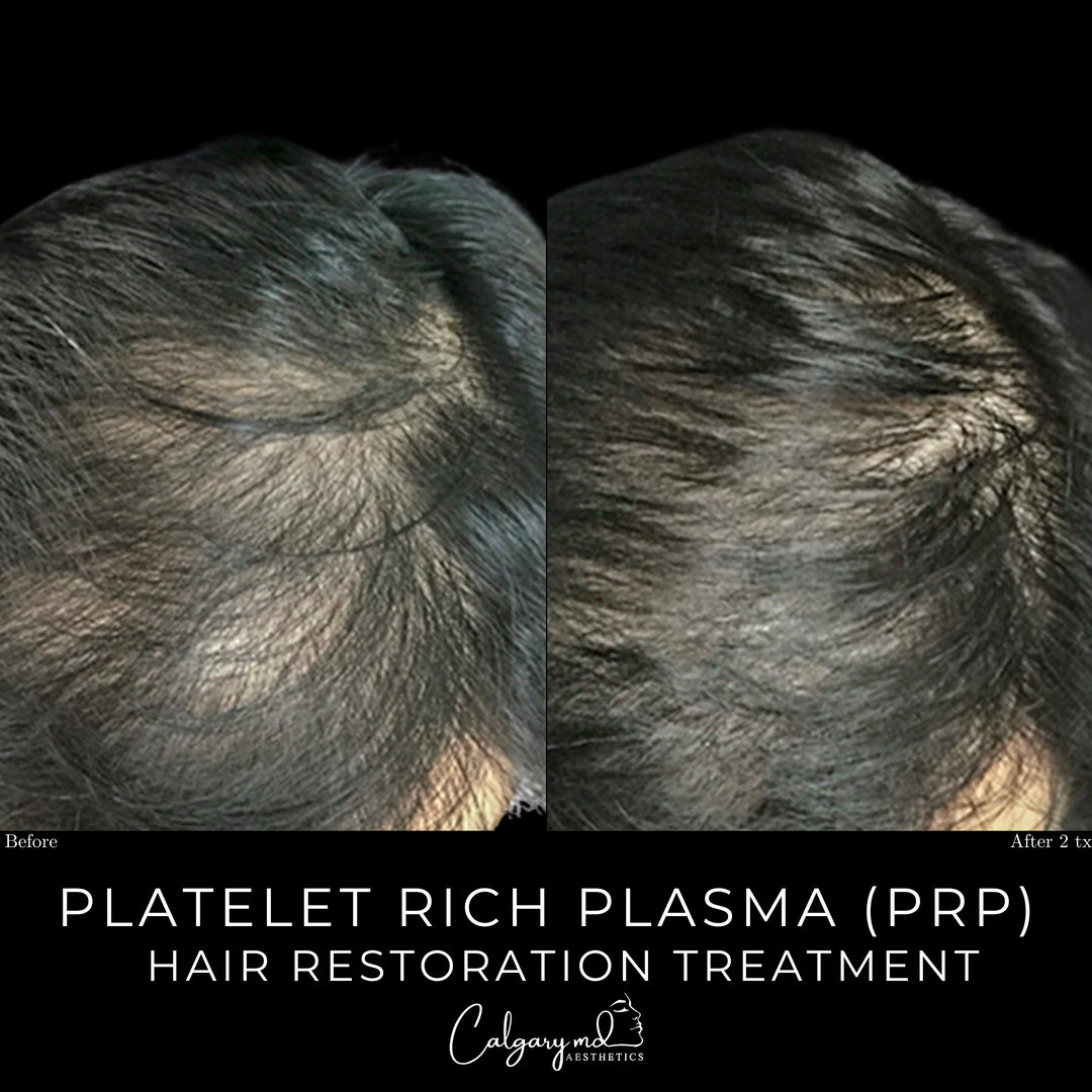 Hair growth results after two sessions of PRP Hair Restoration treatment! *​​​​​​​​
​​​​​​​​
Book your series today to accelerate hair growth, increase hair volume, and reduce hair fall:​​​​​​​​
𝗖𝗮𝗹𝗹: 403.242.1411​​​​​​​​ ⁣​​​​​​​​​​​​​​​​​​​​​​​​​​​​​​​​⁣​​​​​​​​​​​​​​​​​​​​​​​​⁣​​​​​​​​​​​​​​​​
𝗕𝗼𝗼𝗸 𝗼𝗻𝗹𝗶𝗻𝗲: calgarymdaesthetics.com/booking/⁣​​​​​​​​​​​​​​​​
​​​​​​​​
*series of 3-4 recommended for optimal results.