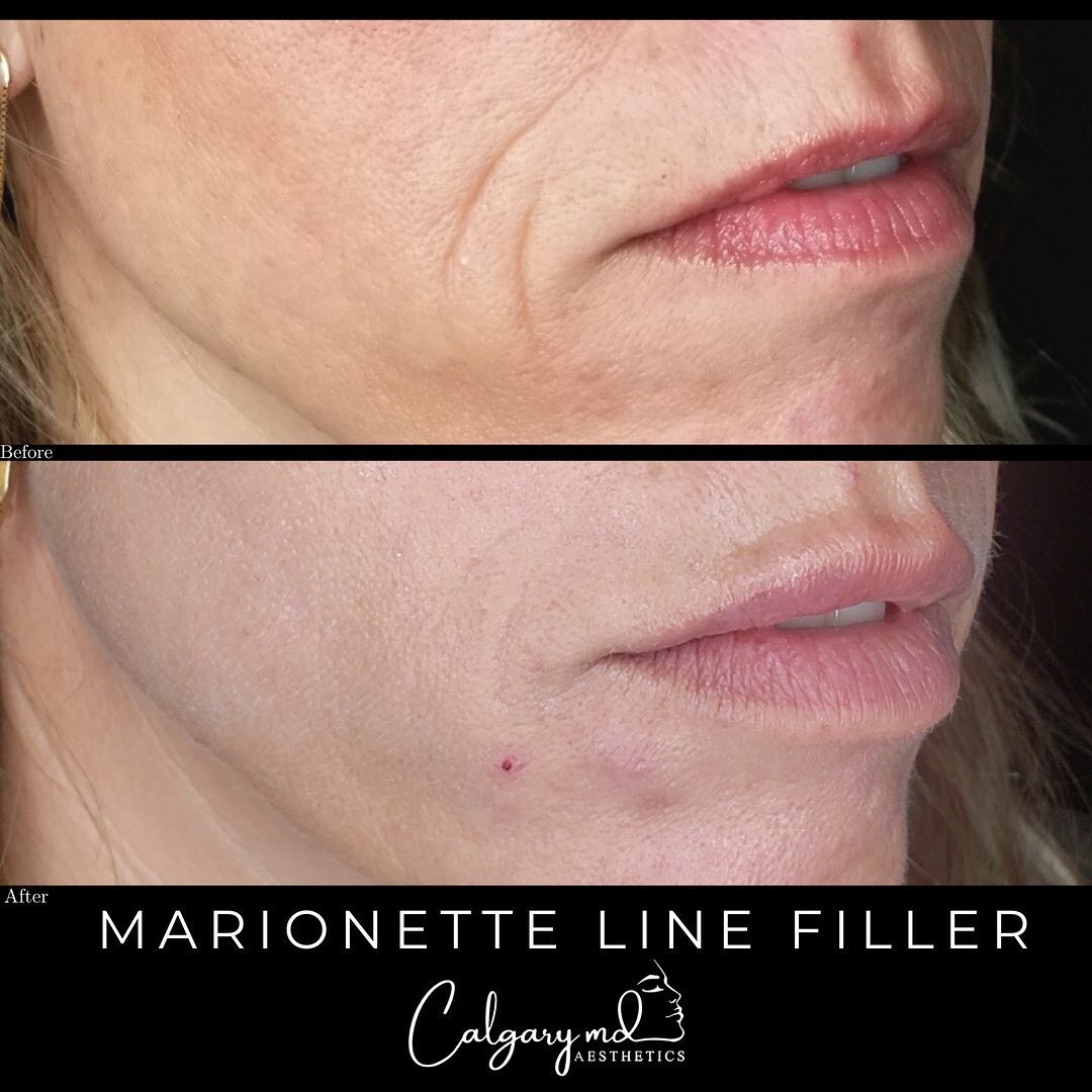 Bye Bye Marionette Lines!!
⠀⠀⠀⠀⠀⠀⠀⠀⠀
Book in with Tammy - @injection.artistry for your next dermal filler appointment.
⠀⠀⠀⠀⠀⠀⠀⠀⠀
Reminder - 15% cash back with a minimum spend of $750 on all Restylane filler (while supplies last). 
⠀⠀⠀⠀⠀⠀⠀⠀⠀
​𝗖𝗮𝗹𝗹: 403.242.1411​​​​​​​​ ⁣​​​​​​​​​​​​​​​​​​​​​​​​​​​​​​​​⁣​​​​​​​​
𝗕𝗼𝗼𝗸 𝗼𝗻𝗹𝗶𝗻𝗲: calgarymdaesthetics.com/booking/ ​​​​​​​​​​​​​​​​⁣​​​​​​​​
