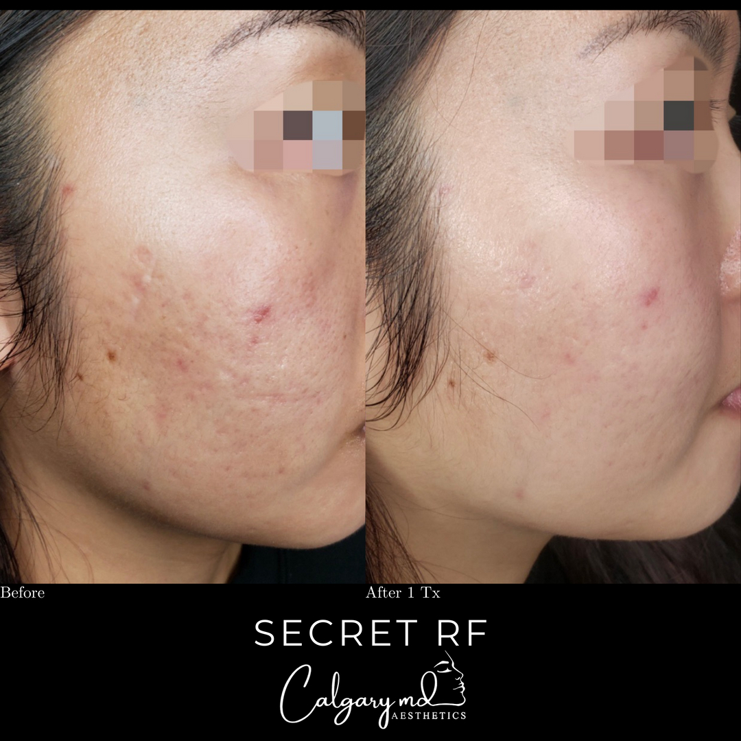 Why do we love the Secret RF ?!?... because it works!​​​​​​​​
​​​​​​​​
Amazing results can be achieved after 1 session* when treatments are customized and performed by highly skilled Healthcare Professionals. ​​​​​​​​
​​​​​​​​
Secret RF uses microneedles to deliver fractional Radio Frequency (RF) energy into varying levels of the skin including the deeper layers where treatment is most beneficial. RF energy heats tissue to stimulate new collagen and elastin while microneedles deliver this energy to the scarred problem areas below the skin.​​​​​​​​
​​​​​​​​
Book your complimentary consultation today to find out if this is a good treatment option for you.​​​​​​​​
​​​​​​​​
𝗖𝗮𝗹𝗹: 403.242.1411​​​​​​​​ ⁣​​​​​​​​​​​​​​​​​​​​​​​​​​​​​​​​⁣​​​​​​​​​​​​​​​​
𝗕𝗼𝗼𝗸 𝗼𝗻𝗹𝗶𝗻𝗲: calgarymdaesthetics.com/booking/ ​​​​​​​​​​​​​​​​⁣​​​​​​​​​​​​​​​​
​​​​​​​​
- treatment performed by @injection.artistry​​​​​​​​
- please do not repost or reproduce without expressed written consent​​​​​​​​
*optimal results after 3 sessions