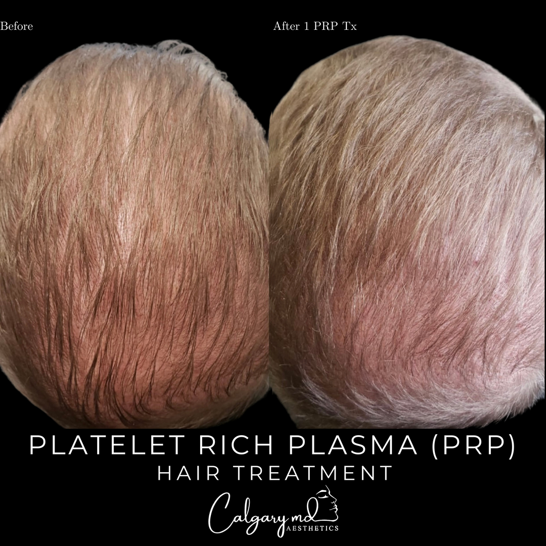 Suffering from hair loss?​​​​​​​​
​​​​​​​​
PRP is a great solution! PRP hair restoration is a non-surgical hair rejuvenation treatment that uses your own plasma to accelerate hair growth, increase volume, and reduce hair fall. ​​​​​​​​
​​​​​​​​
If you are struggling with hair loss, contact us today for a free consultation to discuss the many treatment options we offer at our clinic.​​​​​​​​
​​​​​​​​
𝗖𝗮𝗹𝗹: 403.242.1411​​​​​​​​ ⁣​​​​​​​​​​​​​​​​​​​​​​​​​​​​​​​​⁣​​​​​​​​​​​​​​​​​​​​​​​​
𝗕𝗼𝗼𝗸 𝗼𝗻𝗹𝗶𝗻𝗲: calgarymdaesthetics.com/booking/ ​​​​​​​​​​​​​​​​⁣​​​​​​​​​​​​​​​​​​​​​​​​
​​​​​​​​​​​​​​​​
- treatment performed by @injection.artistry​​​​​​​​​​​​​​​​
- please do not repost or reproduce without expressed written consent​​​​​​​​
