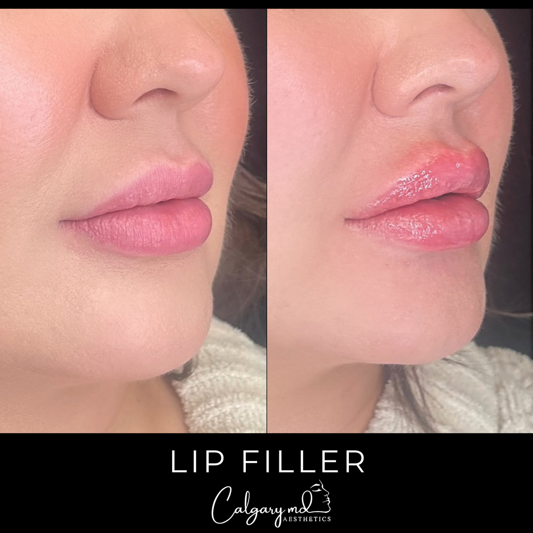 Beautiful lips by @thelipgirlyouneed!​​​​​​​​
​​​​​​​​
She added some height to her upper lip and an overall plump in volume for this lovely lady.​​​​​​​​
​​​​​​​​
Book in today with Melia!​​​​​​​​
​​​​​​​​
𝗖𝗮𝗹𝗹: 403.242.1411​​​​​​​​ ⁣​​​​​​​​​​​​​​​​​​​​​​​​​​​​​​​​⁣​​​​​​​​​​​​​​​​​​​​​​​​​​​​​​​​
𝗕𝗼𝗼𝗸 𝗼𝗻𝗹𝗶𝗻𝗲: calgarymdaesthetics.com/booking/ ​​​​​​​​​​​​​​​​⁣​​​​​​​​​​​​​​​​​​​​​​​​​​​​​​​​
​​​​​​​​​​​​​​​​​​​​​​​​
- please do not repost or reproduce without expressed written consent​​​​​​​​