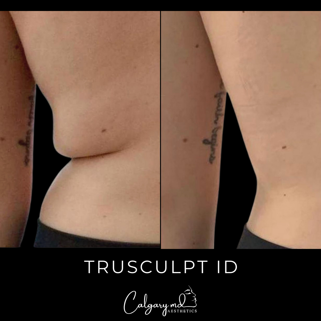 Have you heard about truSculpt iD?​​​​​​​​
​​​​​​​​
This non-invasive fat distraction machine uses radio frequency energy to heat and destroy the fat tissue without harming the skin or muscle.​​​​​​​​
​​​​​​​​
The treatment is quick and effective, with an average of 24% fat reduction in the treatment area. ​​​​​​​​
​​​​​​​​
Book your free consultation to find out if this is the treatment option you have been looking for!